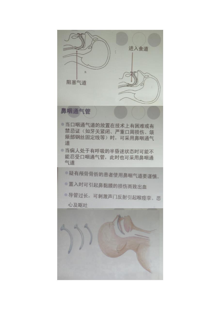 在紧急情况下还可建立应急气道做为可靠气道的暂时替代_第2页