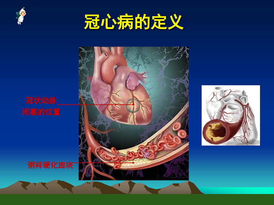 冠心病的临床表现、诊断与治疗-罗素新(ppt)_第4页