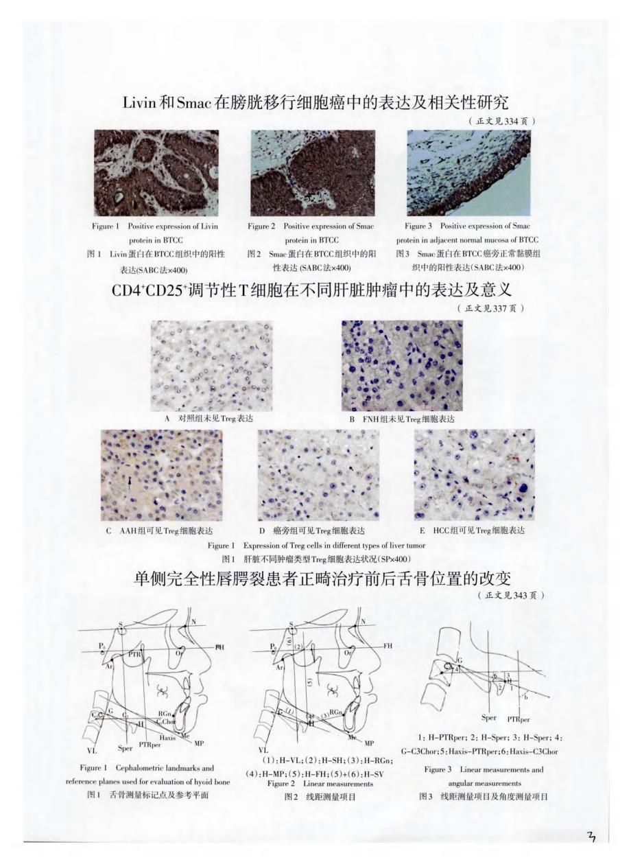 单侧完全性唇腭裂患者正畸治疗前后舌骨位置的改变_第4页