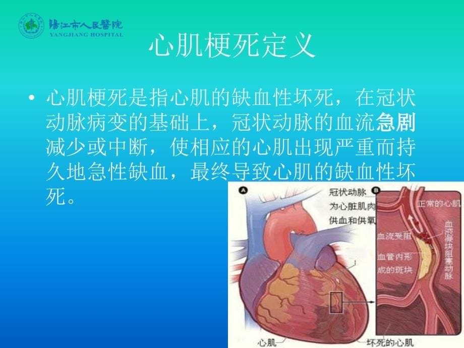 急性心肌梗死的判断、处理和预防常识_第5页