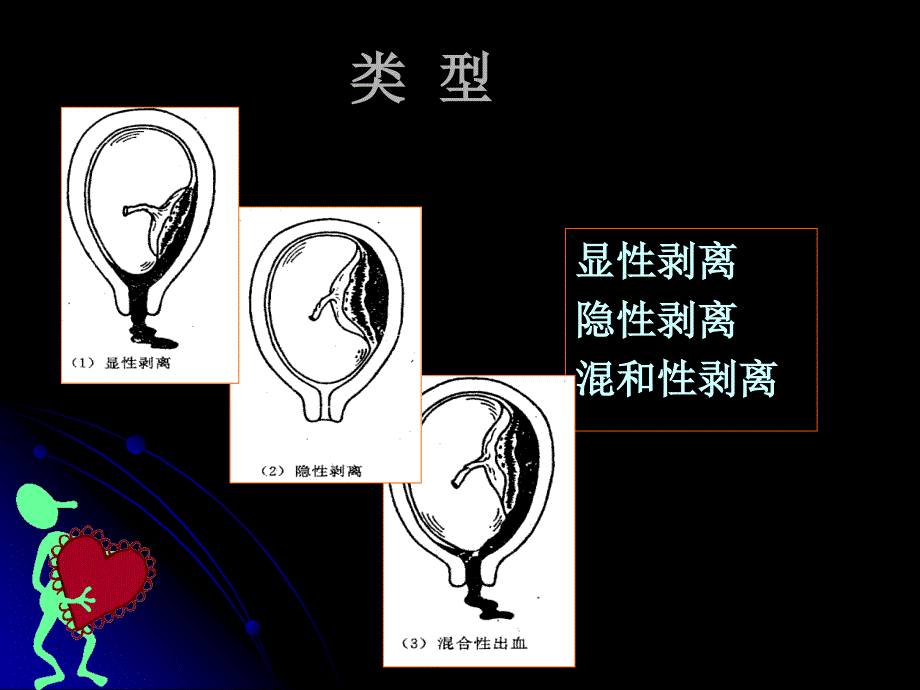 国家级精品课《妇产科学》胎盘早剥_第4页