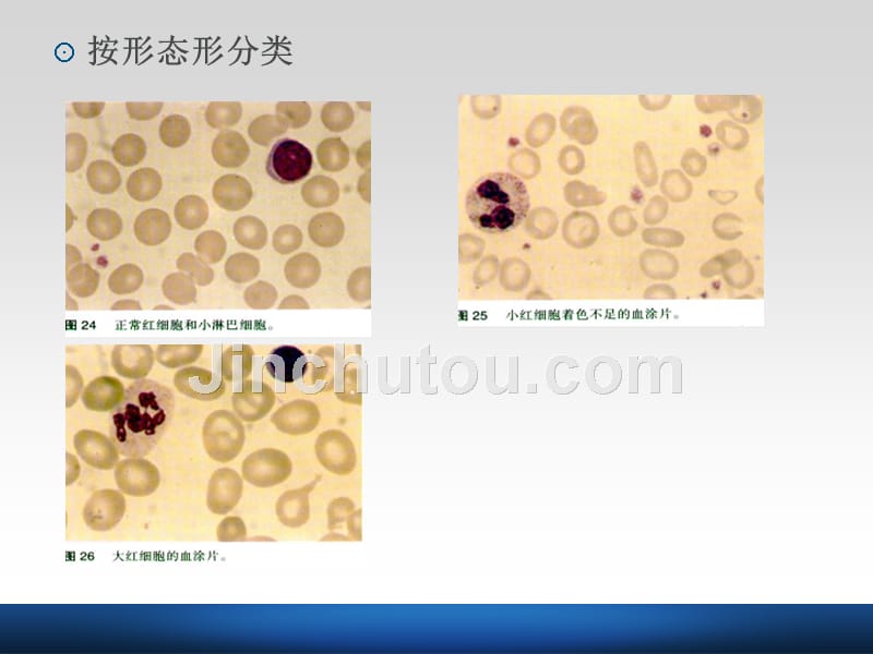 【医学课件】贫血诊断与鉴别诊断1_第4页