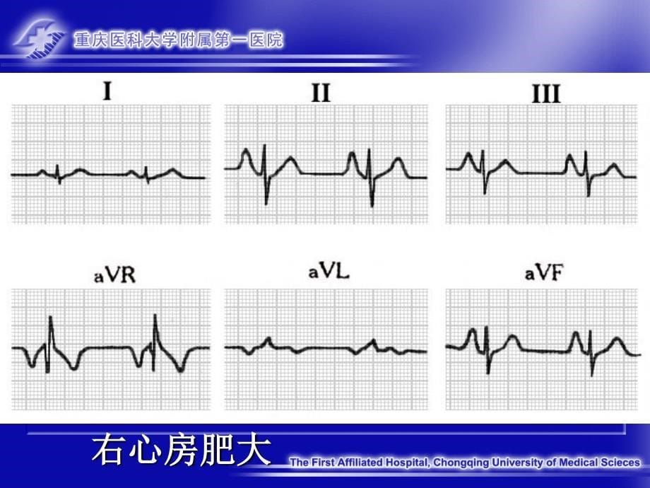 异常心电图(重庆医科大学临床学院心内科)_第5页