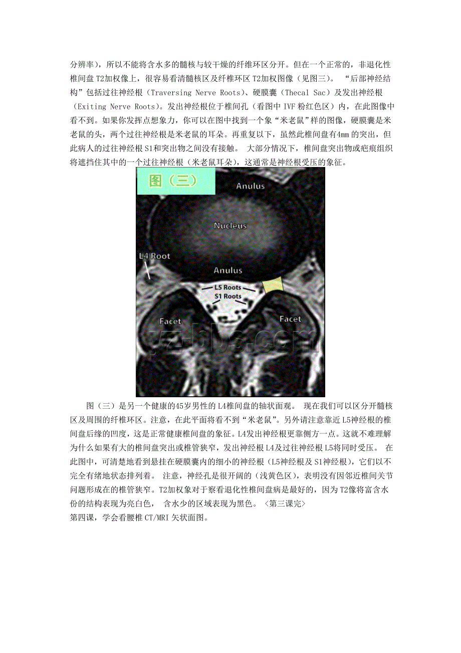 腰椎间盘突出ct和mri_第4页