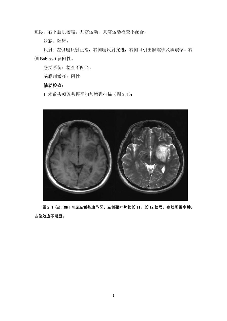 天坛医院神经内科病例-中枢神经系统炎性假瘤_第2页