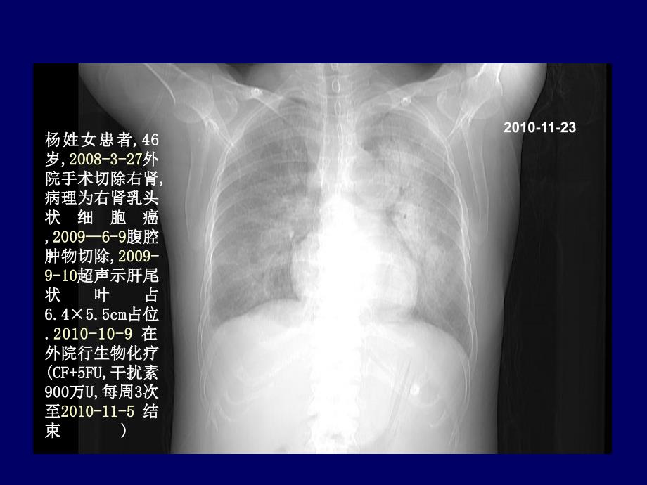 肾癌靶向治疗省肿瘤大会吴晓安_第3页