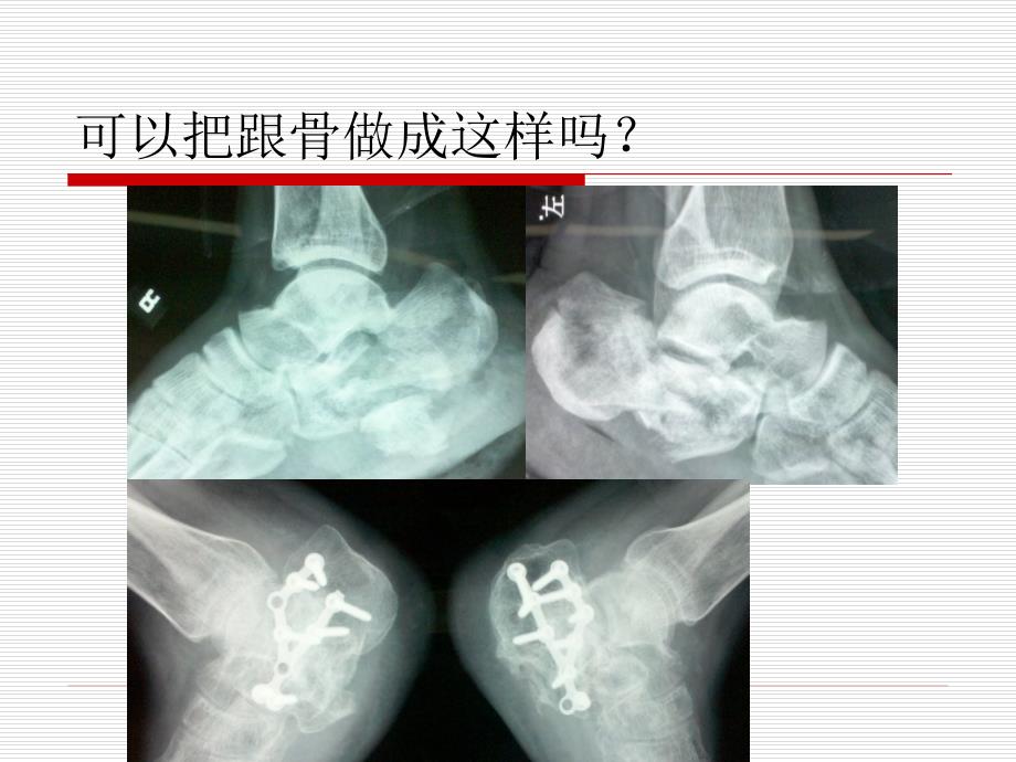 跟骨骨折的治疗_第3页