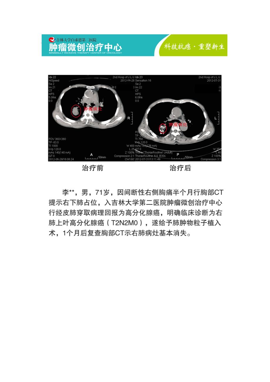 肺癌的粒子植入治疗术_第2页