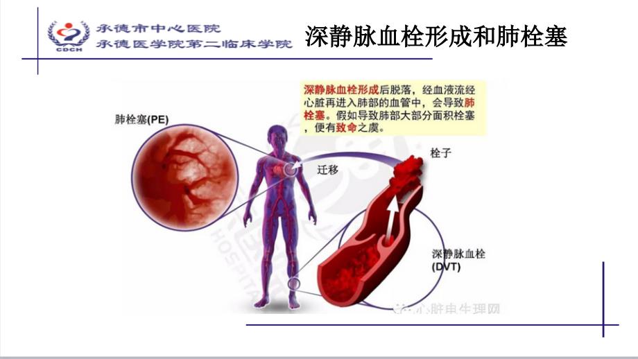 肺栓塞修改_第2页