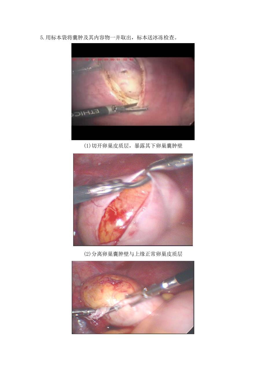 腹腔镜下卵巢囊肿剥除术_第2页