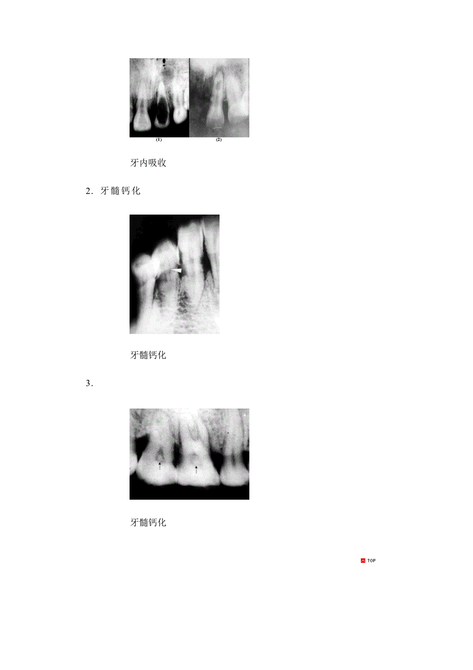 龋病,牙髓病,根尖周病,牙周炎,牙外伤,牙根折断_第3页