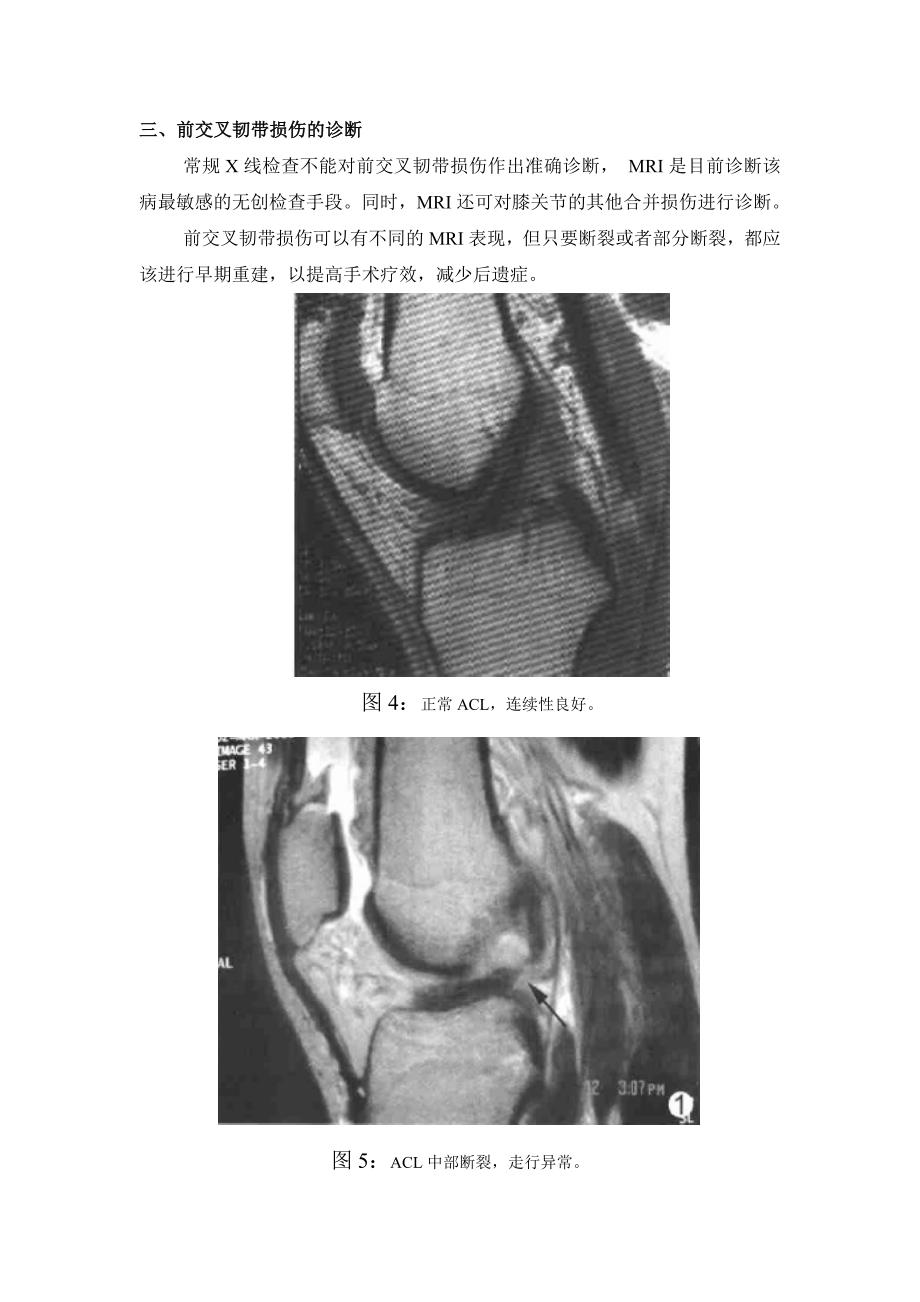 前交叉韧带损伤患者须知_第3页