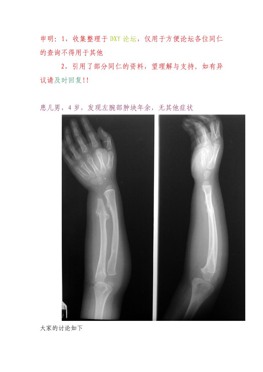 骨肌系统 多发性骨软骨瘤_第1页