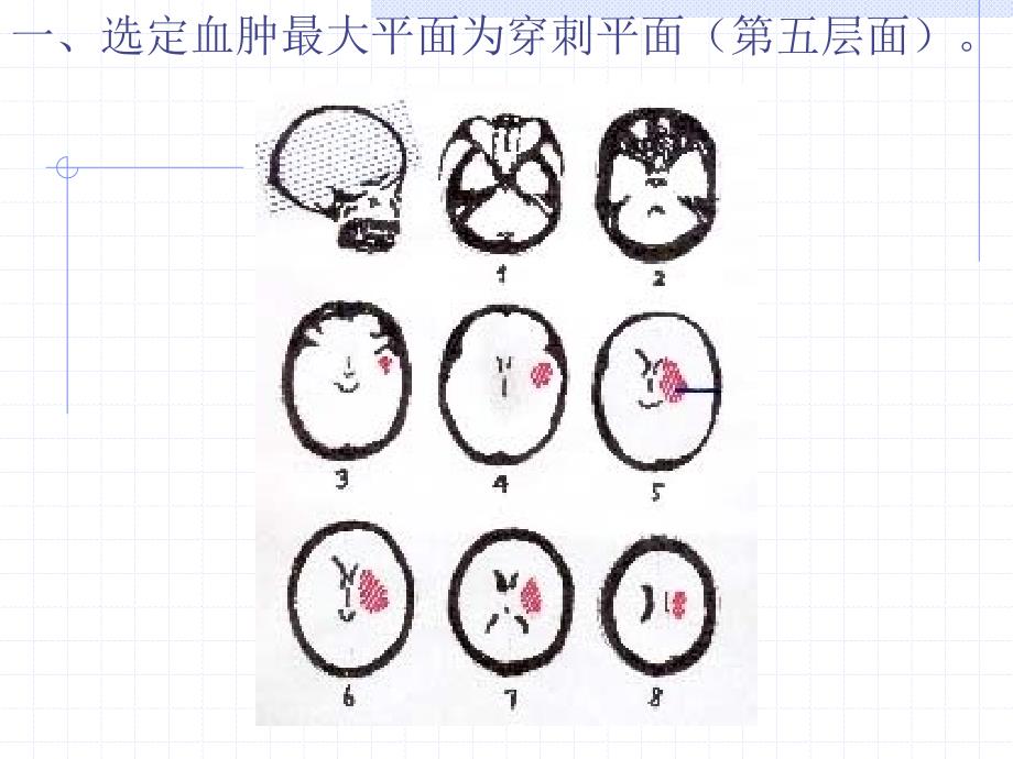 颅内血肿CT片定位_第2页