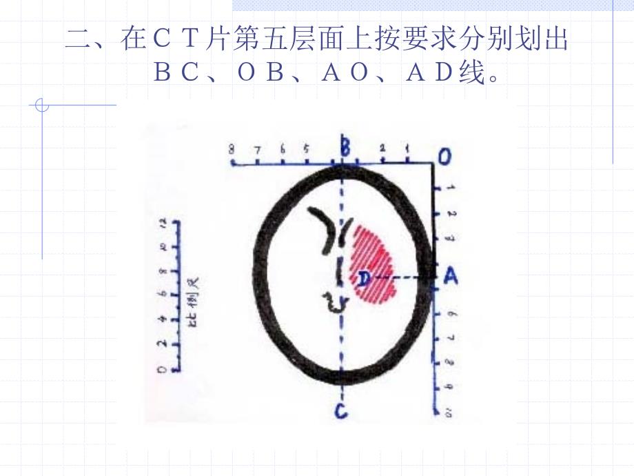 颅内血肿CT片定位_第3页