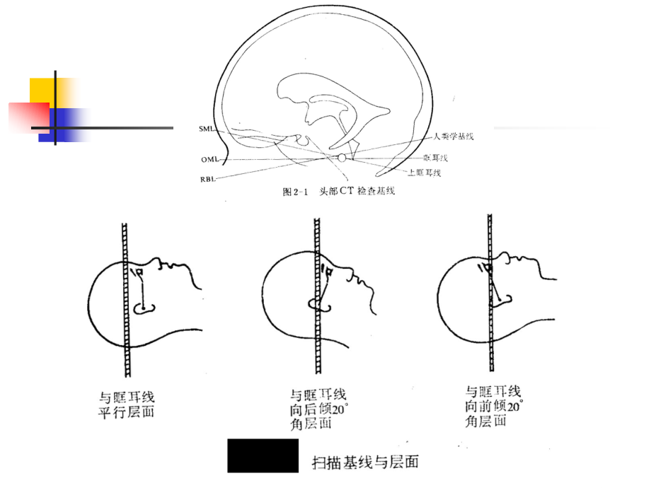 颅脑CT诊断1幻灯片_第3页