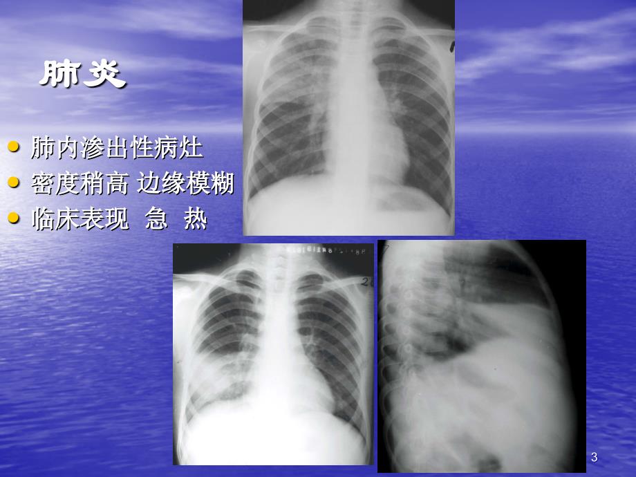 简化记忆X线、CT、B超-执业医师 技能考试幻灯片_第3页