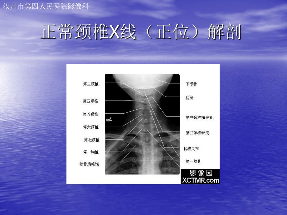 颈椎病01幻灯片_第2页