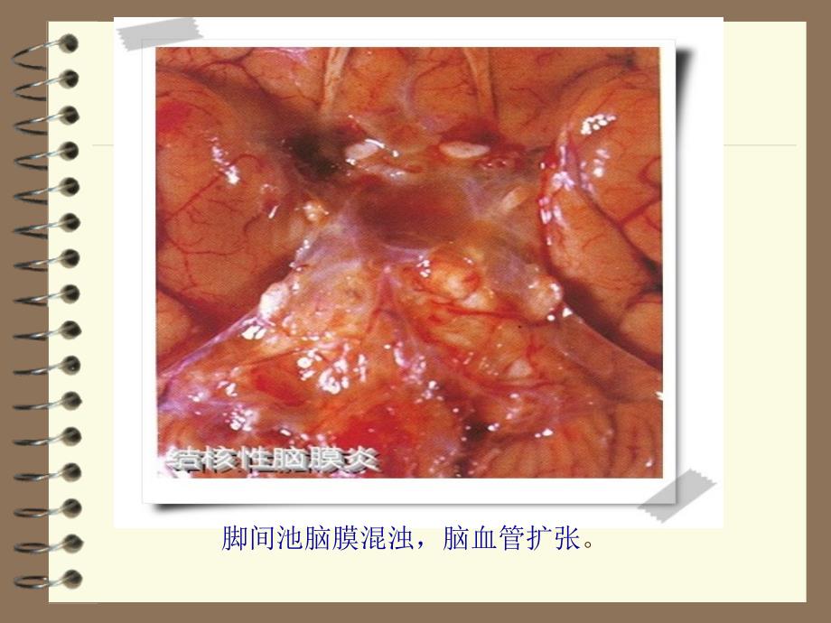 结核性脑膜炎幻灯片1_第3页