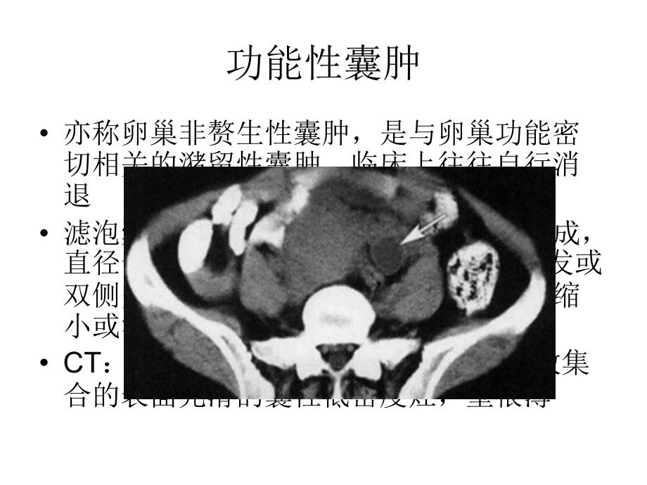 卵巢良性病变幻灯片_第3页