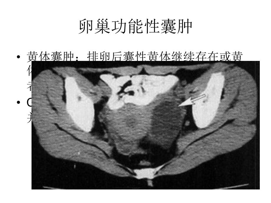 卵巢良性病变幻灯片_第4页