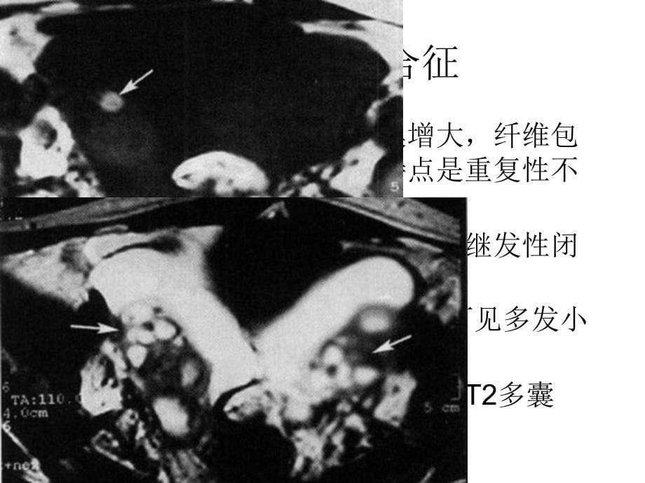 卵巢良性病变幻灯片_第5页