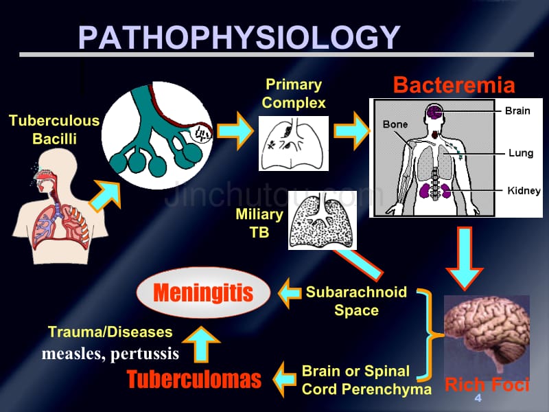 结核性脑膜炎-英文幻灯片_第4页