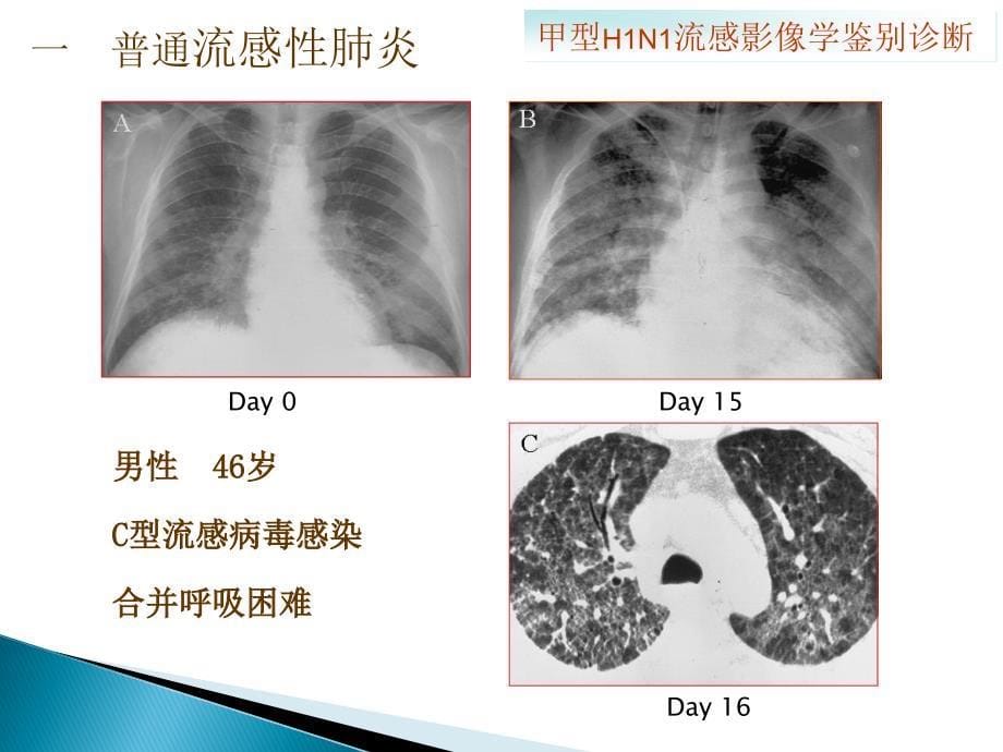 甲型H1N1流感的影像学鉴别诊断幻灯片_第5页