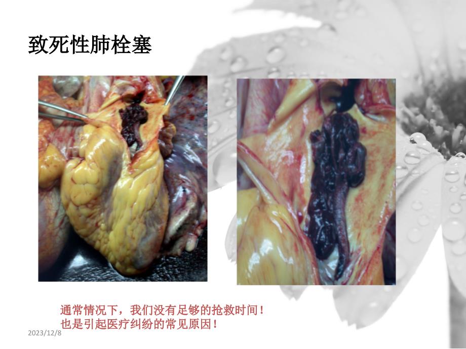 静脉血栓症的指南解读幻灯片_第4页