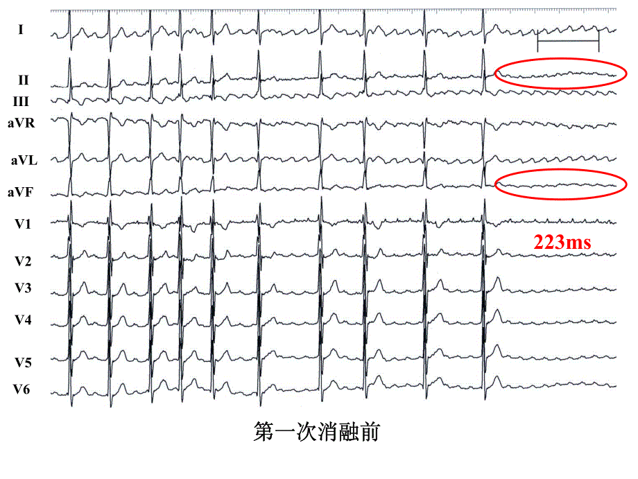 疤痕性房速1例：标测的误区_第3页