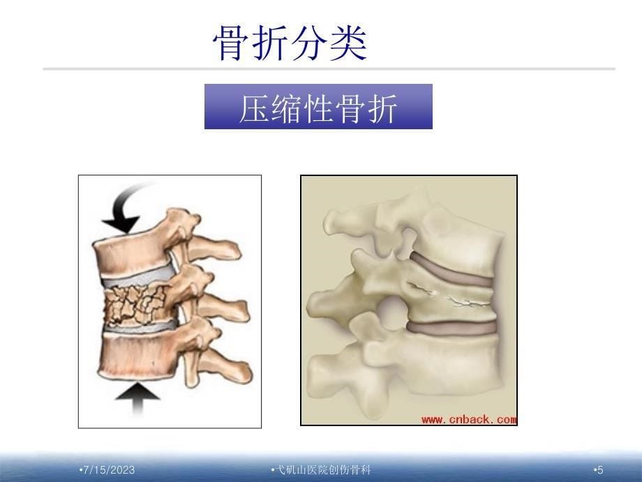 胸腰椎骨折护理查房_第5页