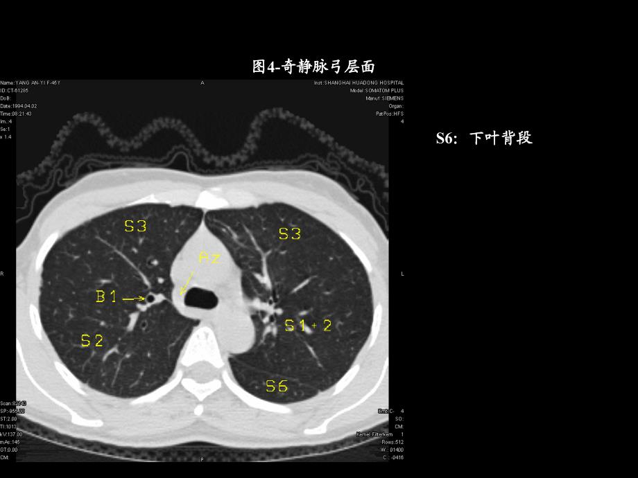 胸部ct解剖与诊断_第4页