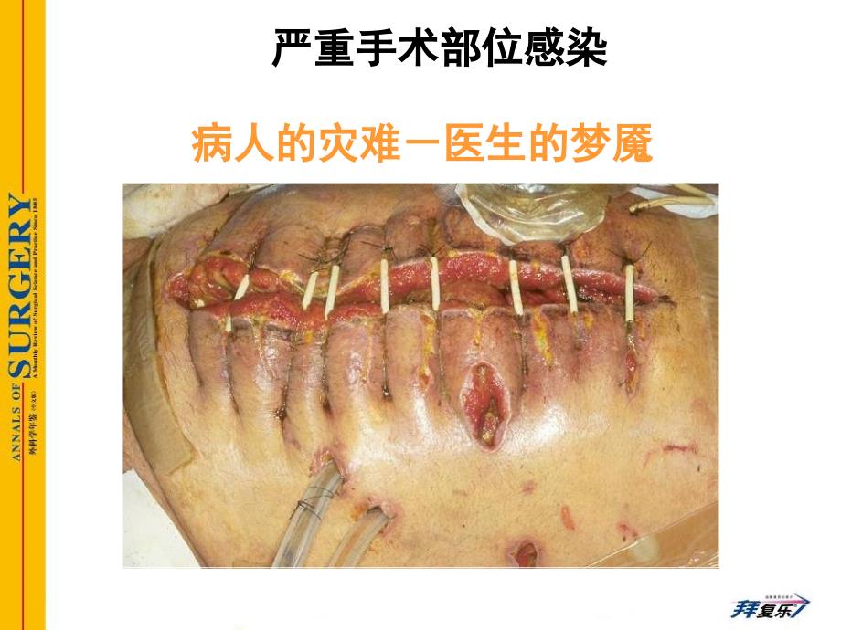 预防性抗菌素与外科部位感染控制_第4页