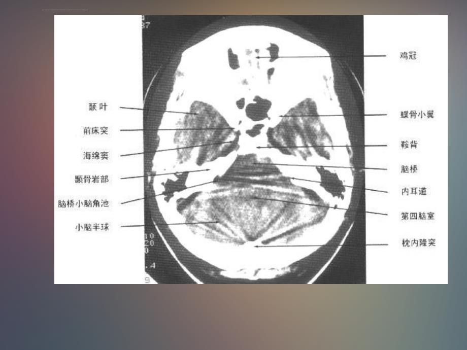 正常头颅ct及mri解剖_第3页