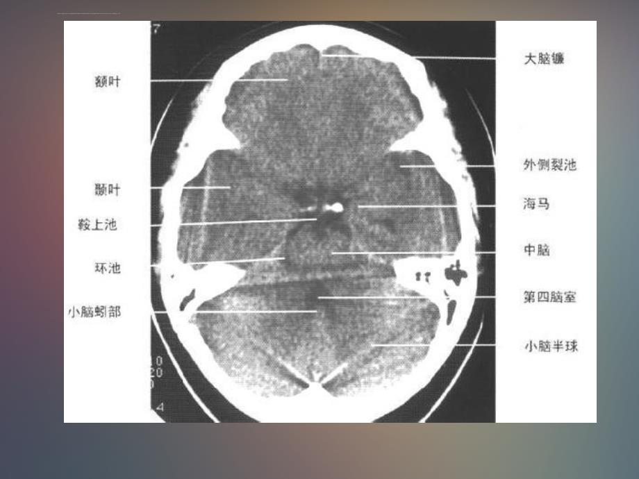 正常头颅ct及mri解剖_第4页