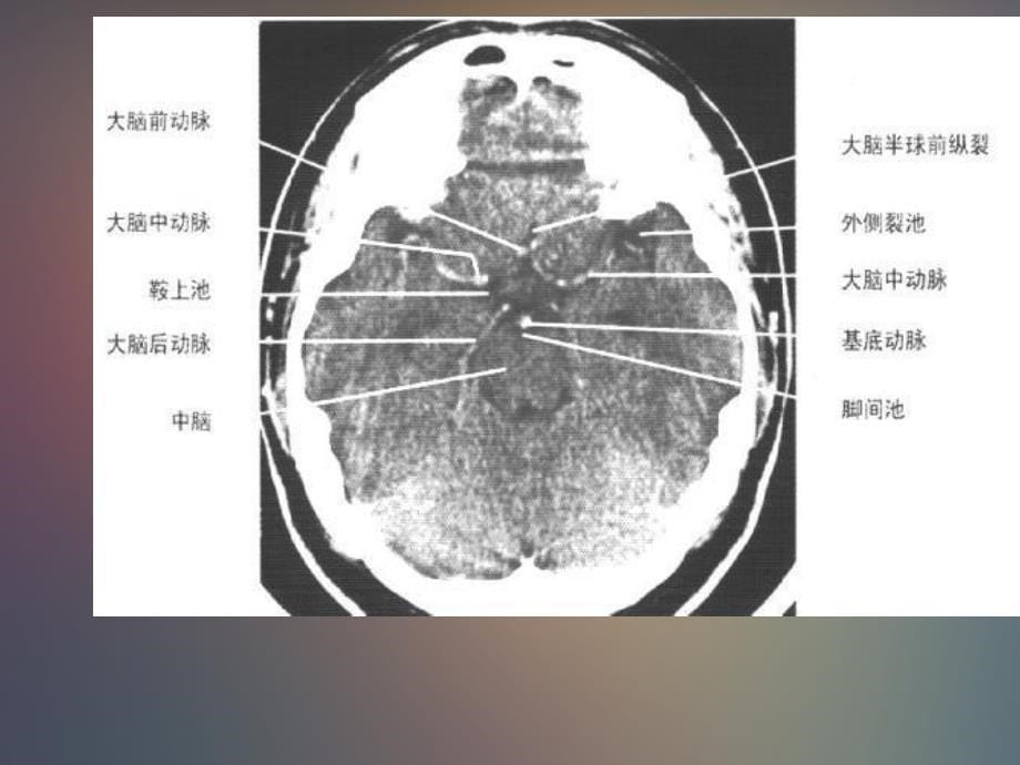 正常头颅ct及mri解剖_第5页