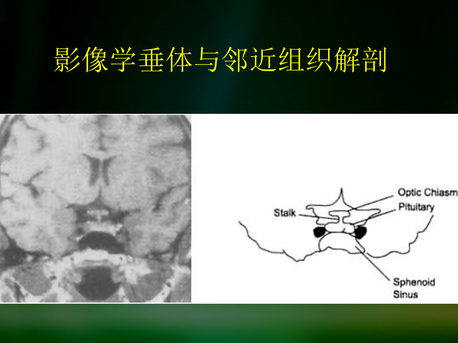 垂体瘤_第4页