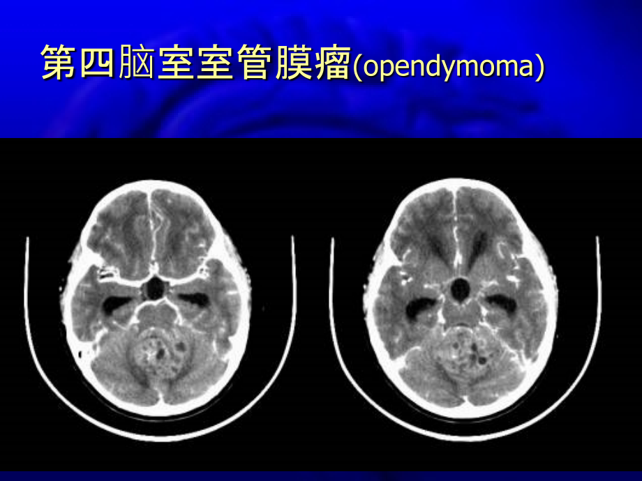 颅内和椎管内肿瘤_第4页