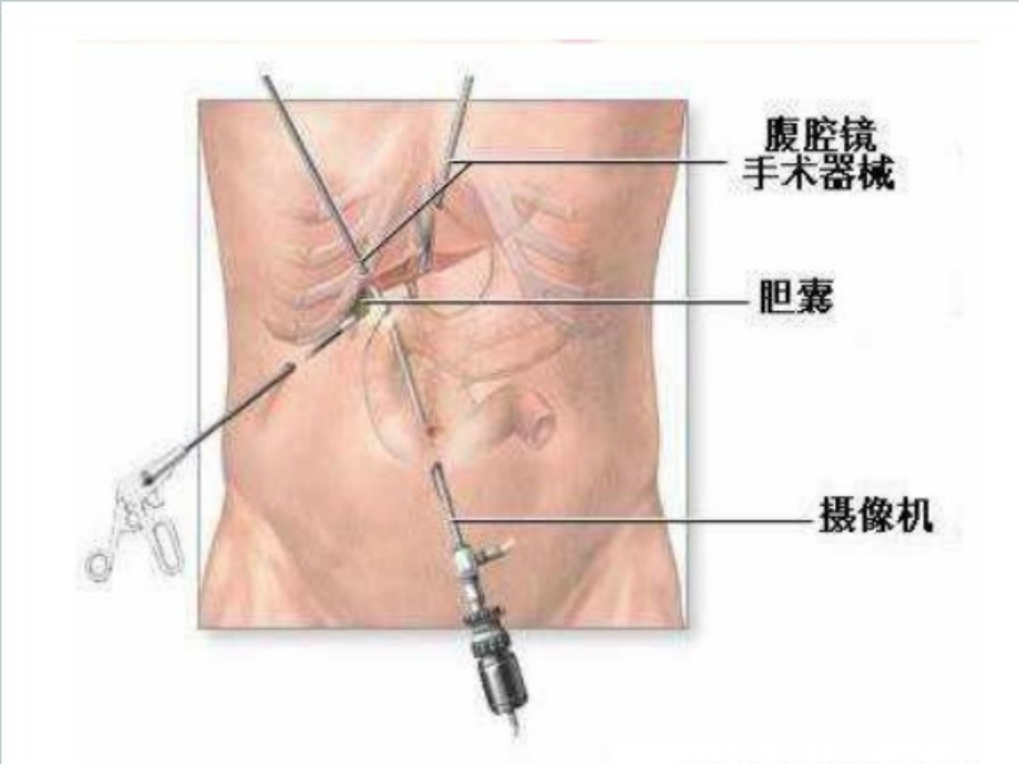 腹腔镜围手术期护理袁钰霞 课件._第5页