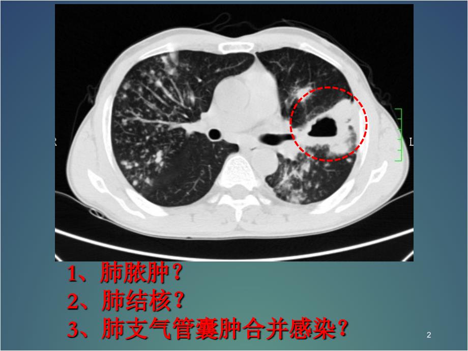 肺肿瘤PPT课件_第2页