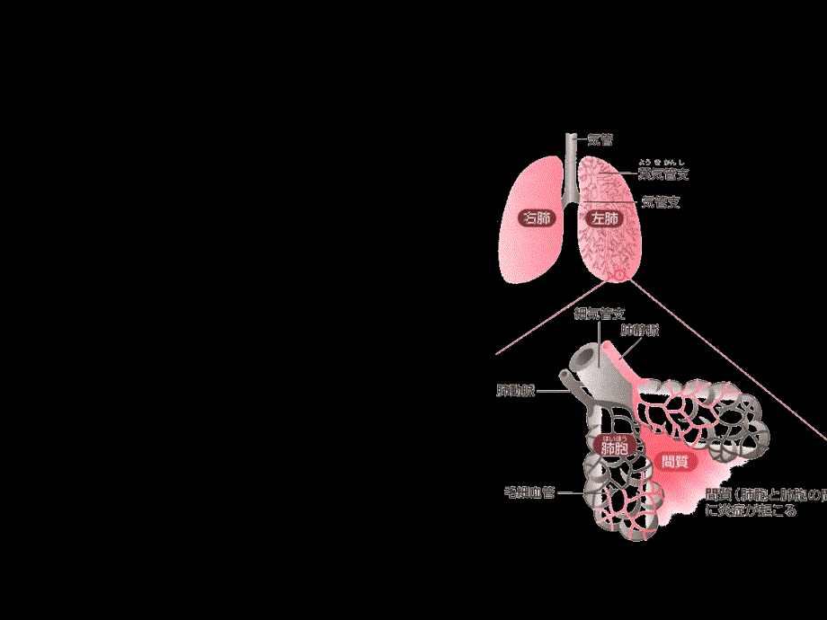 肺炎病人的护理医学PPT_第3页