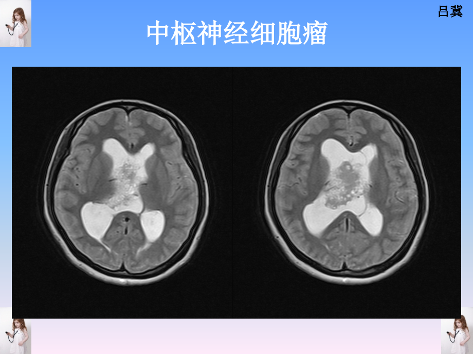 医影在线--CNS疾病影像图库(1)_第3页