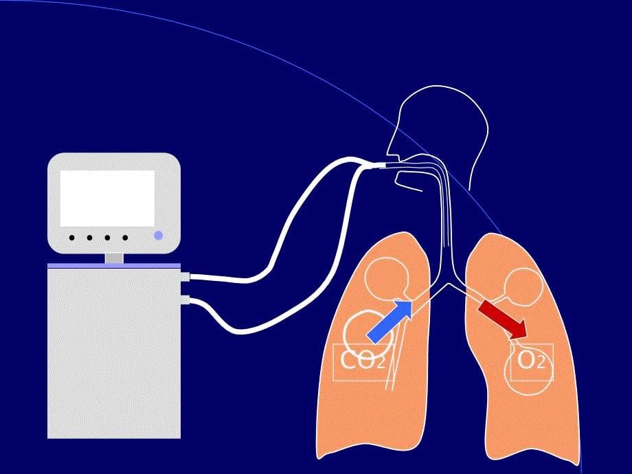 机械通气_第5页
