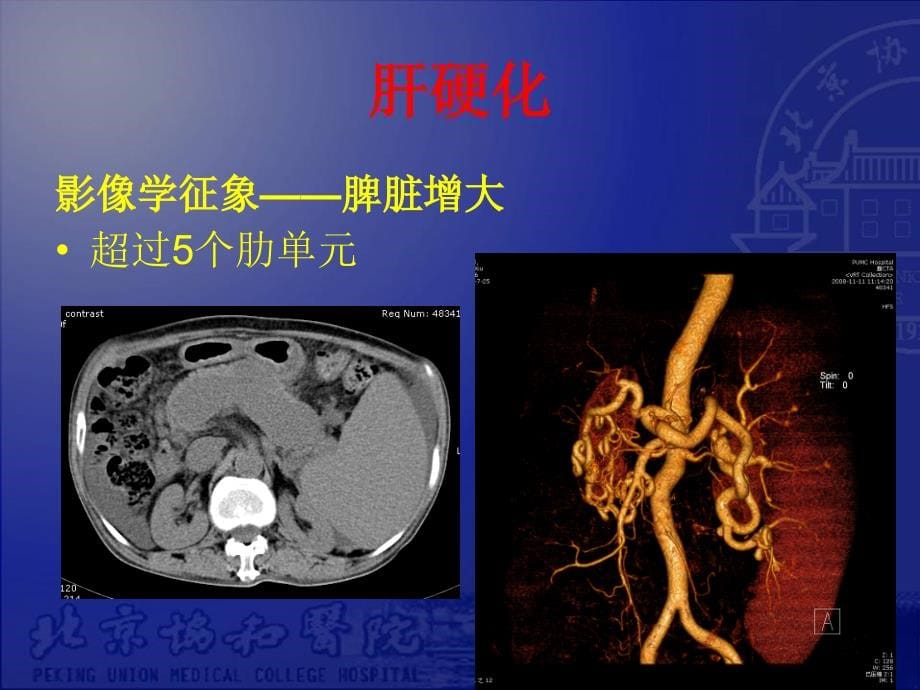 腹部实质脏器疾病影像学表现_第5页