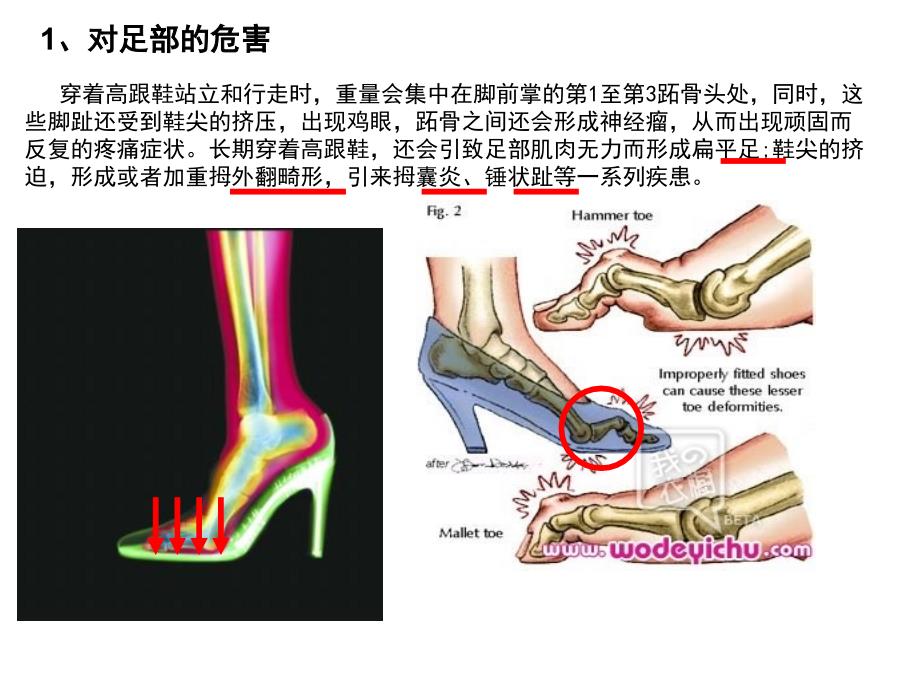 高跟鞋对关节危害_第1页