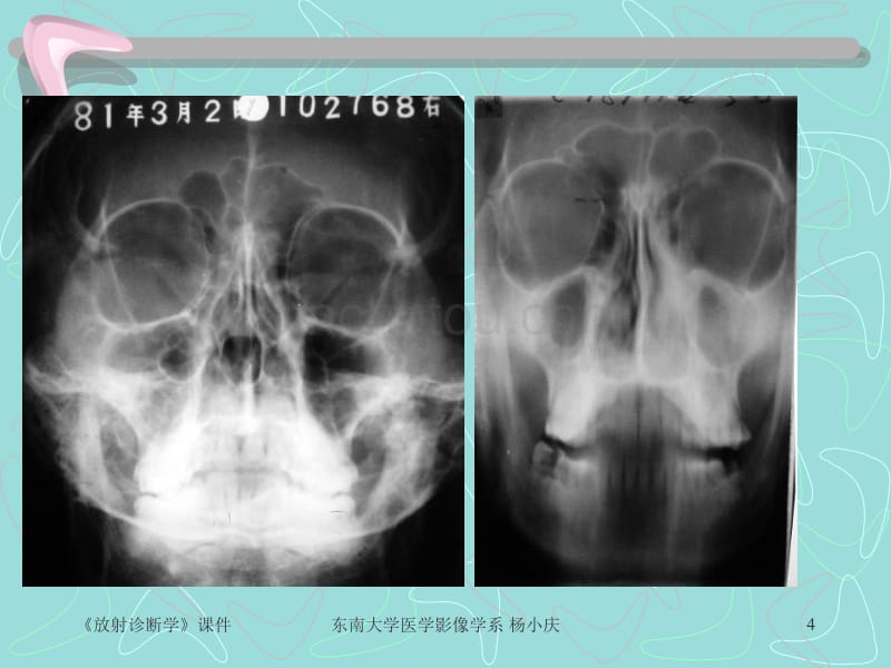 五官系统x线诊断_第4页