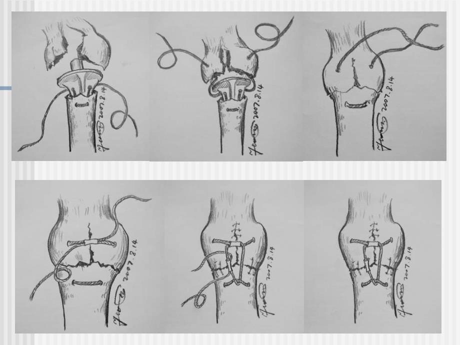 肩关节置换治疗肱骨近端骨折与康复_第5页