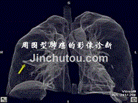 周围型肺癌的影像诊断幻灯片