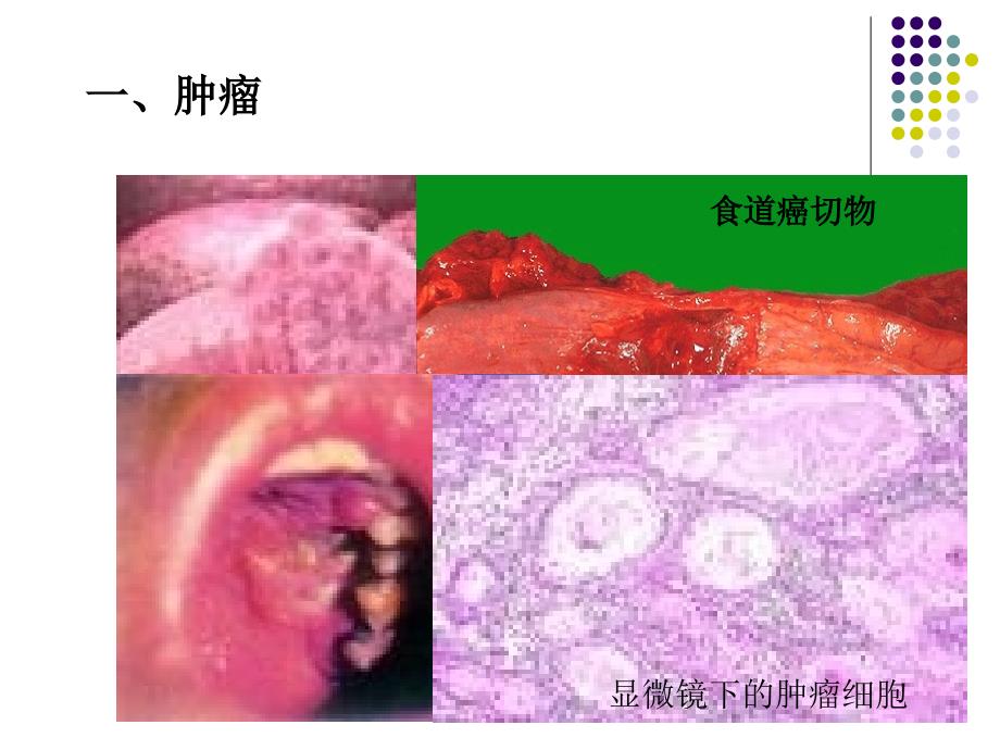 肿瘤和冠心病幻灯片_第2页