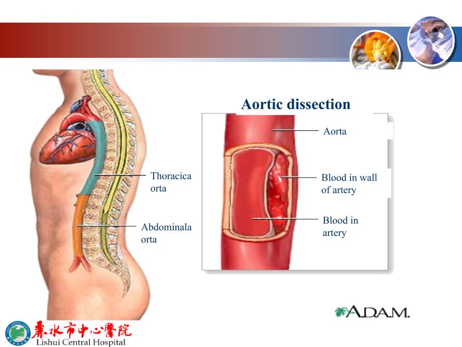 主动脉夹层急诊诊断幻灯片_第4页